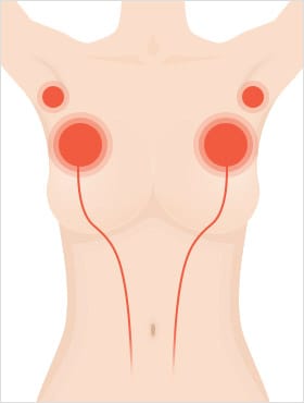 성호르몬의 분비의 영향을 받아 유방이 발달되듯 부유방도 발달