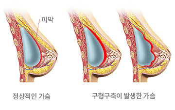 구형구축