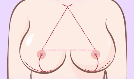 01 수술 후 흉터가 보이지 않도록 헤어라인 안쪽에 비교적 작은 절개창을 만들어줍니다.
