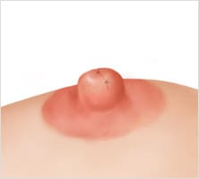V 절개 STEP 04