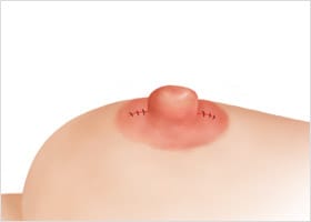 유관 절제 후 봉합하는 방법 STEP 03