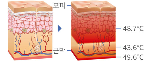 비교적 안전한 레이저, 캄레이저의 치료 원리
