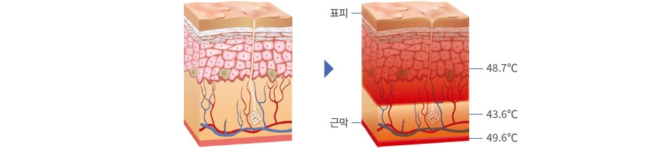 비교적 안전한 레이저, 캄레이저의 치료 원리