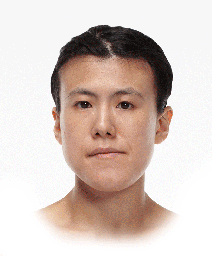 치아를 포함한 아래턱 전체가 길게 전진된 경우 양악 수술 필요