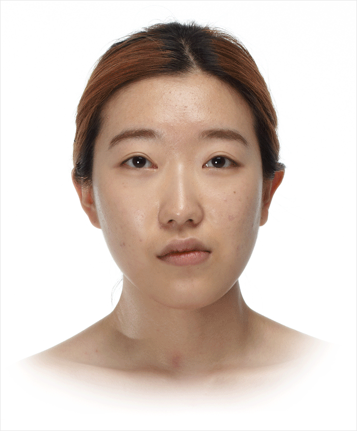 치열의 교합은 정상이고 앞턱이 길게 발달된 경우 앞턱 수술로 개선 가능