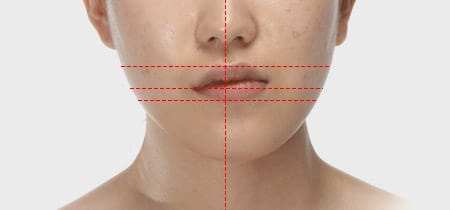 양악의 교합이 틀어져 치아의 수평이 맞지 않는 경우