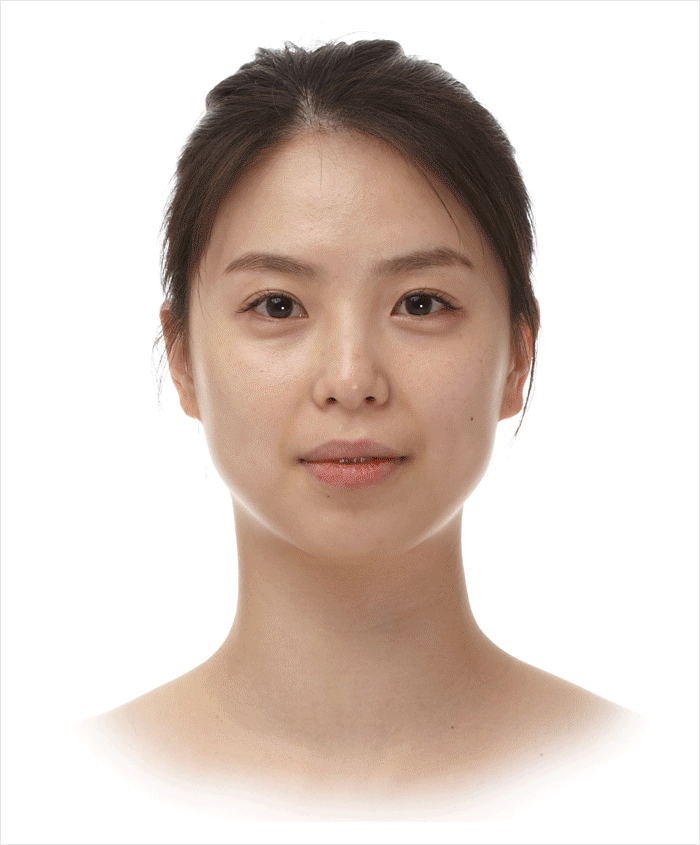 치아를 포함한 아래턱 전체가 뒤로 들어간 경우 양악 수술 필요