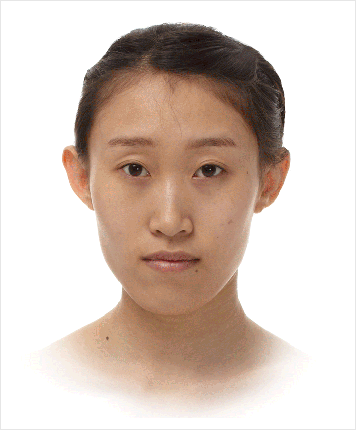 치열의 상태는 정상이지만 앞턱이 충분히 발달되지 못한 경우 앞턱 수술로 개선 가능