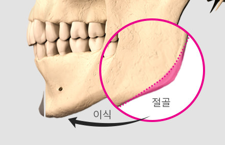 T 자 절골