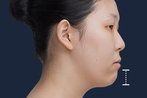턱이 짧은 경우