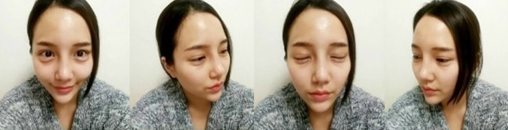 수술 후 6개월