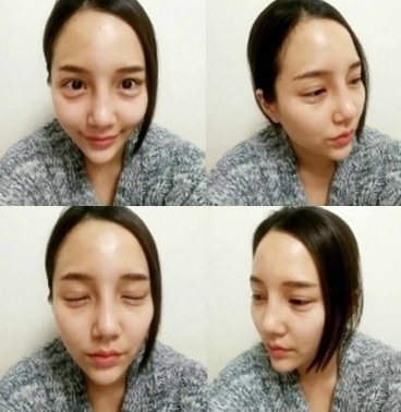 수술 후 6개월