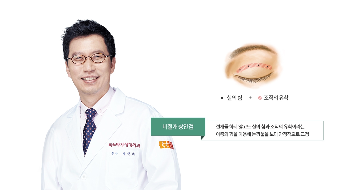비절개 상안검 - 절개를 하지 않고도 실의 힘과 조직의 유착이라는 이중의 힘을 이용해 눈꺼풀을 보다 안정적으로 교정