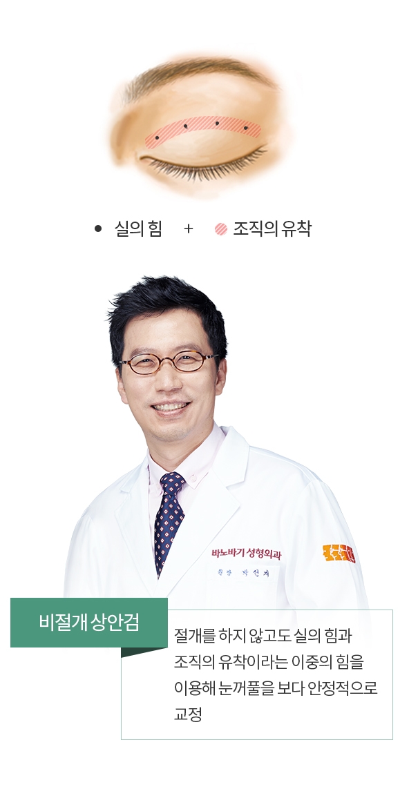 비절개 상안검 - 절개를 하지 않고도 실의 힘과 조직의 유착이라는 이중의 힘을 이용해 눈꺼풀을 보다 안정적으로 교정