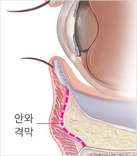 STEP 01 안와격막
