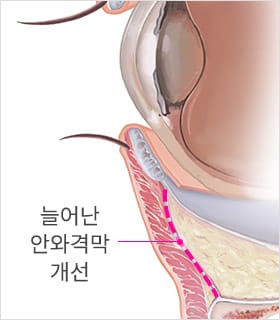 STEP 03 늘어난 안와격막 개선