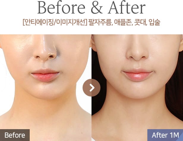 [안티에이징/이미지개선] 팔자주름, 애플존, 콧대