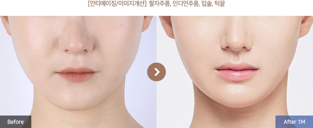 [안티에이징/이미지개선] 팔자주름, 인디언주름, 입술, 턱끝