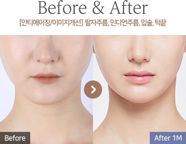 [안티에이징/이미지개선] 팔자주름, 인디언주름, 입술, 턱끝