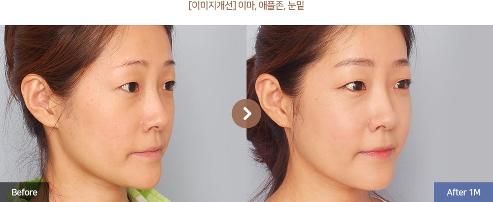 [이미지개선] 이마, 애플존, 눈밑