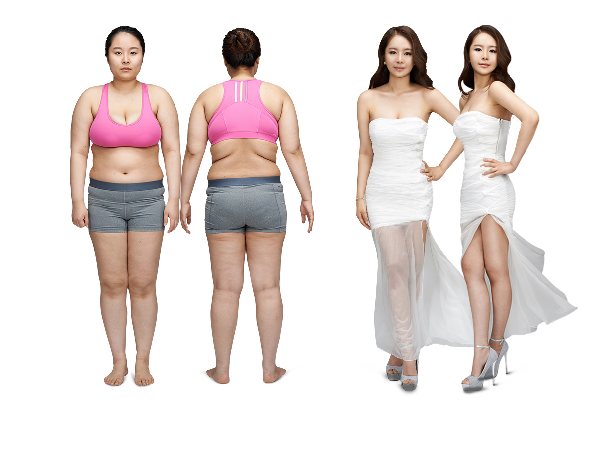 전신지방흡입 모델
