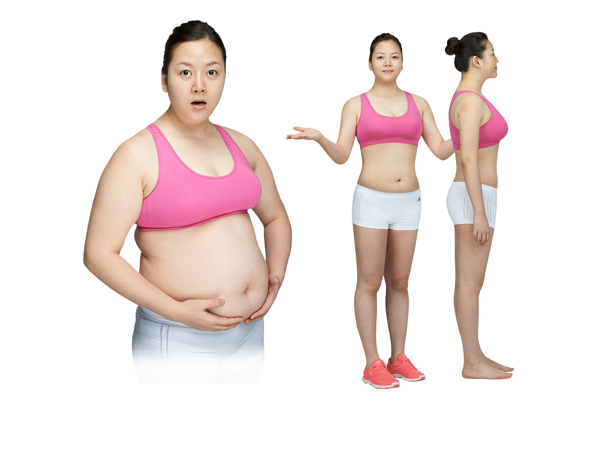 전신지방흡입 모델