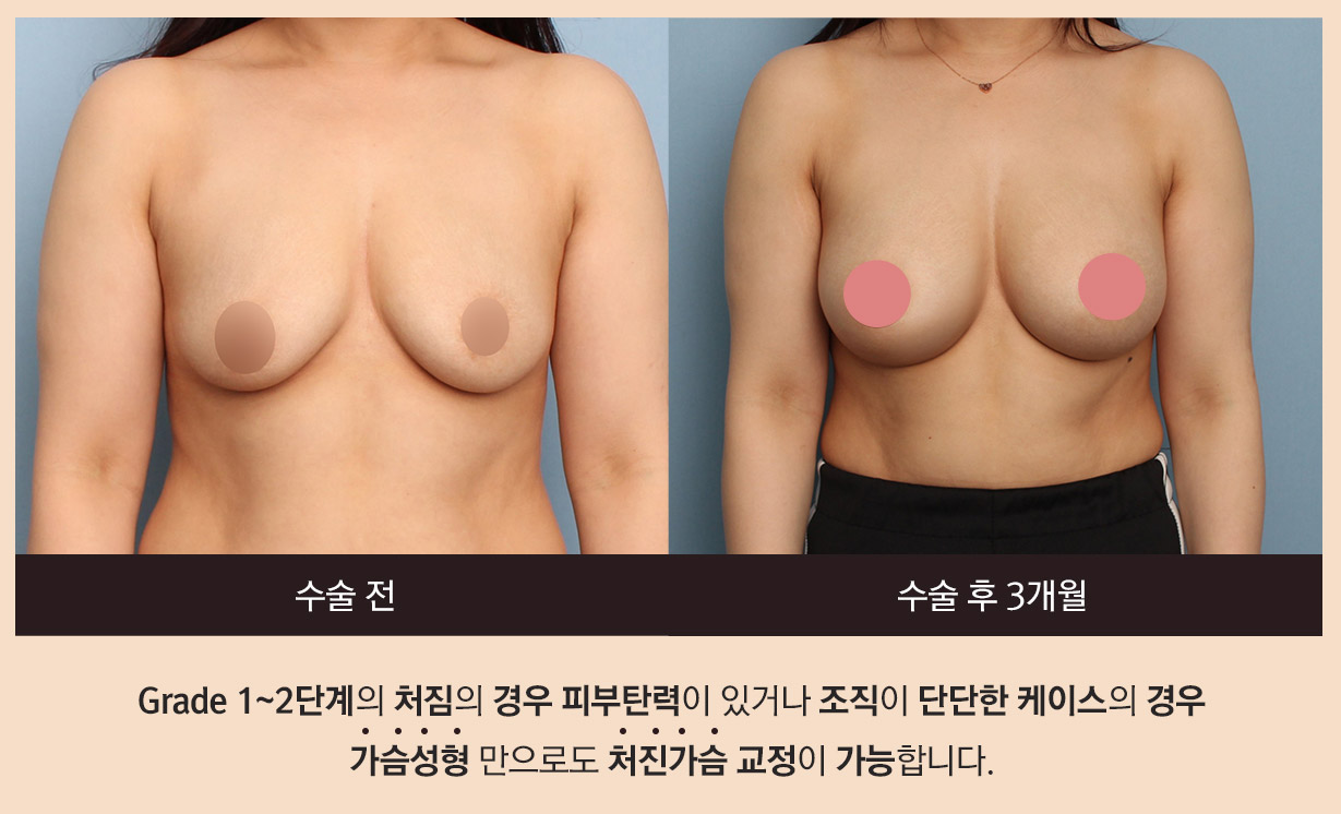 수술 전, 수술 후 3개월 - Grade 1~2단계의 처짐의 경우 피부탄력이 있거나 조직이 단단한 케이스의 경우 가슴성형 만으로도 처진가슴 교정이 가능합니다.