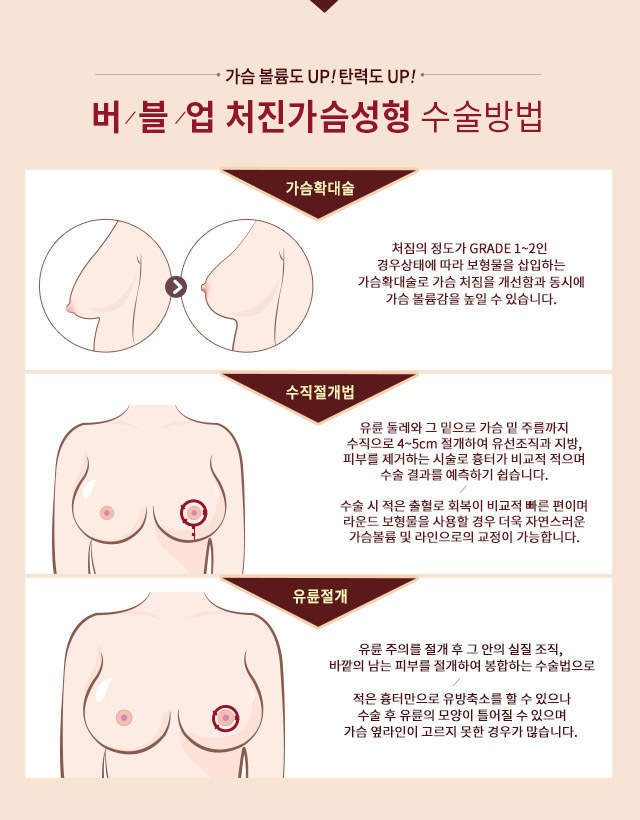 가슴 볼륨도 UP! 탄력도 UP! 버블업 처진가슴성형 수술방법:가슴확대술, 수직절개법, 유륜절개