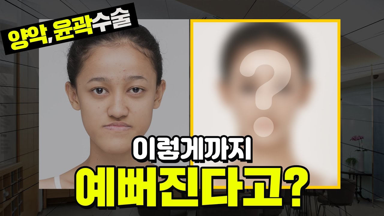 양악, 윤곽 수술로 이렇게까지 예뻐진다
