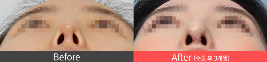 보형물이 비치는 경우