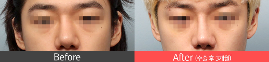 보형물이 움직이는 경우