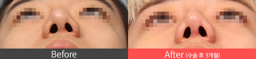 보형물이 움직이는 경우