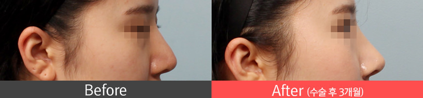콧대가 너무 높거나 낮은 경우