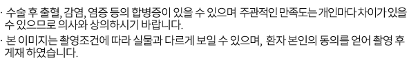 수술 후 출혈, 감염, 염증 등의 합병증이 있을 수 있으며 주관적인 만족도는 개인마다 차이가 있을 수 있으므로 의사와 상의하시기 바랍니다.