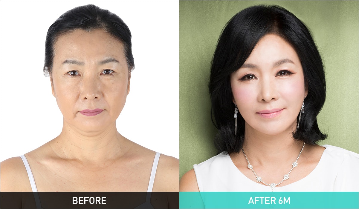 BEFORE & AFTER 6M