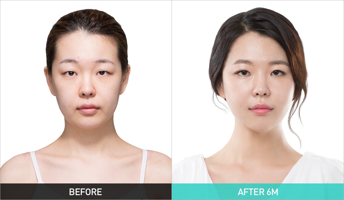 BEFORE & AFTER 6M
