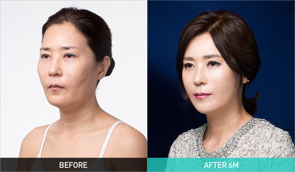 BEFORE & AFTER 6M