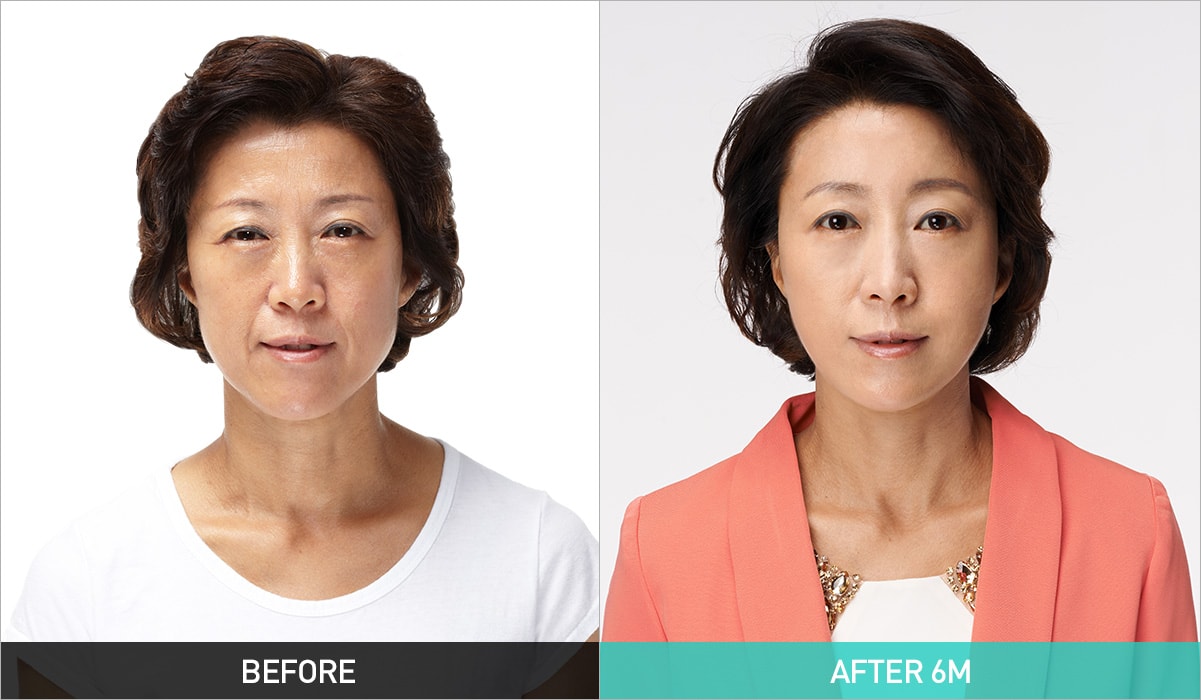BEFORE & AFTER 6M
