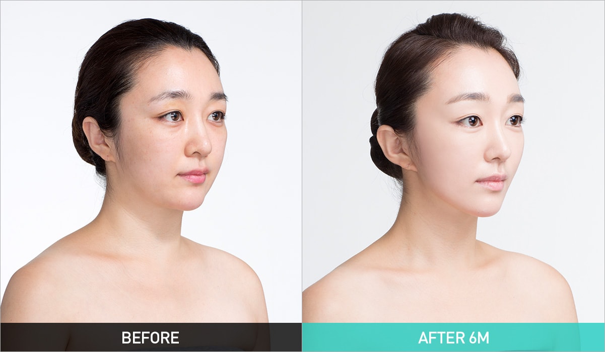 BEFORE & AFTER 6M