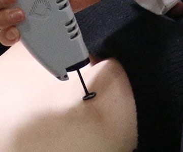 바노바기 피부과와의 협진을 통한 집중적인 흉터 치료