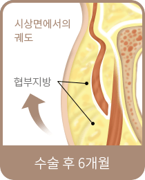 수술 후 6개월