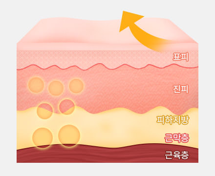 피부만 리프팅 할 때