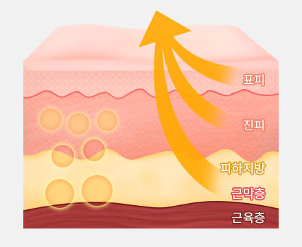 근막층까지 리프팅 할 때