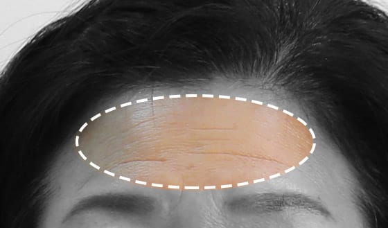 이마 주름이 심한 경우