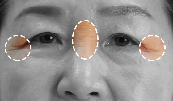 콧잔등과 눈가 주름이 심한 경우