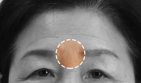 미간 주름이 심한 경우