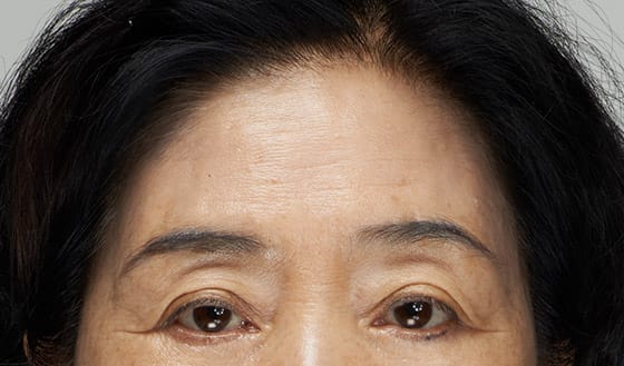 상안면부 전반의 주름으로 인상이 어두워 보이는 경우