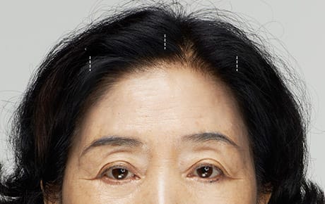 01 수술 후 흉터가 보이지 않도록 헤어라인 안쪽에 비교적 작은 절개창을 만들어줍니다.