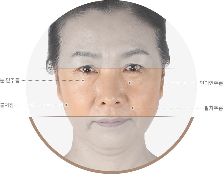 눈 밑주름,인디언주름,볼처림,팔자주름