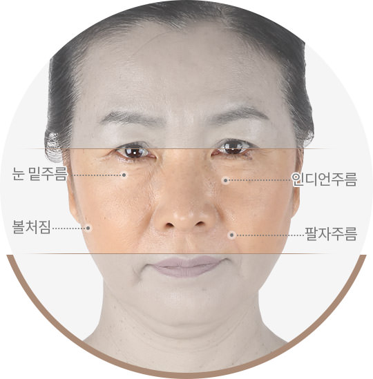 눈 밑주름,인디언주름,볼처림,팔자주름